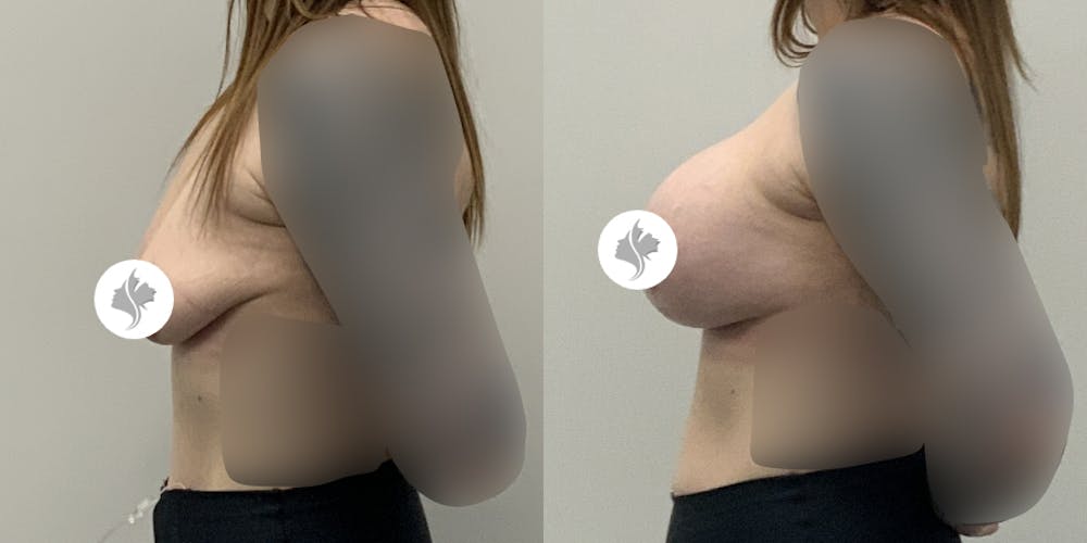This is one of our beautiful breast augmentation with lift patient #3
