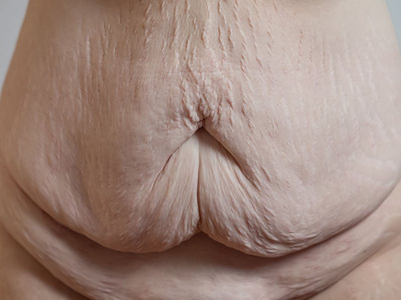 A woman with stretched skin (pannus) on her belly