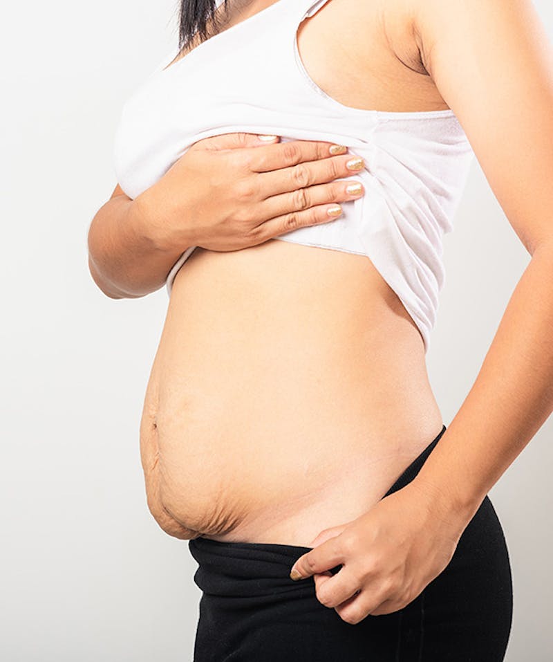 A woman with a bulging abdomen after pregnancy and childbirth