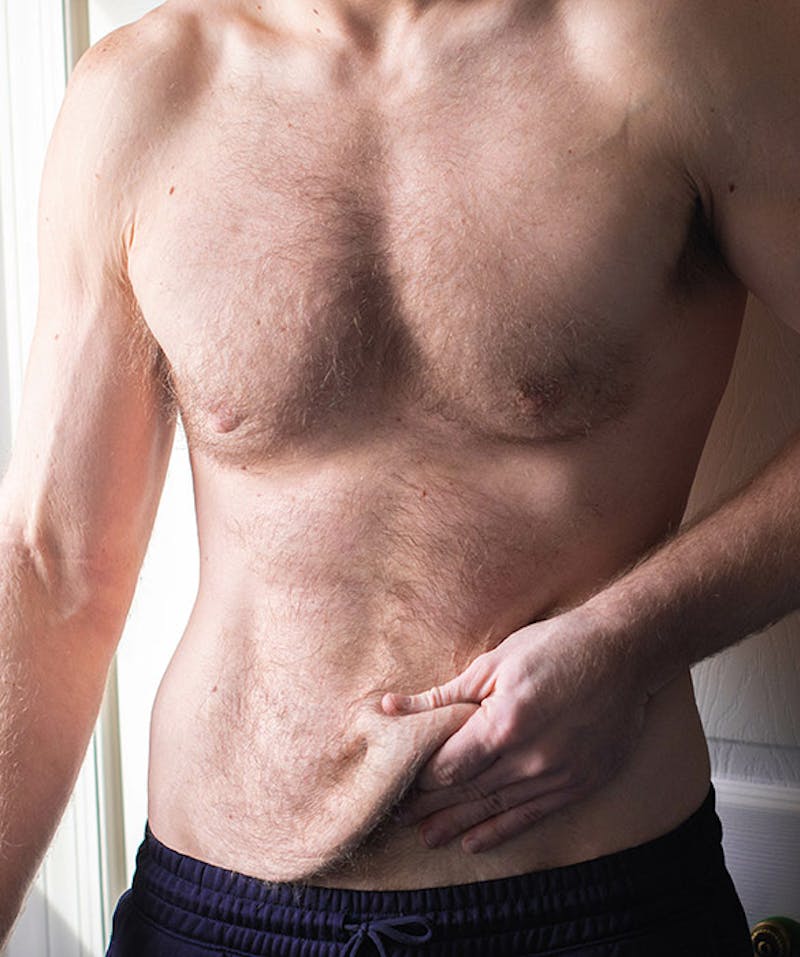 A man grabbing his pannus (stretched skin) after a massive weight loss