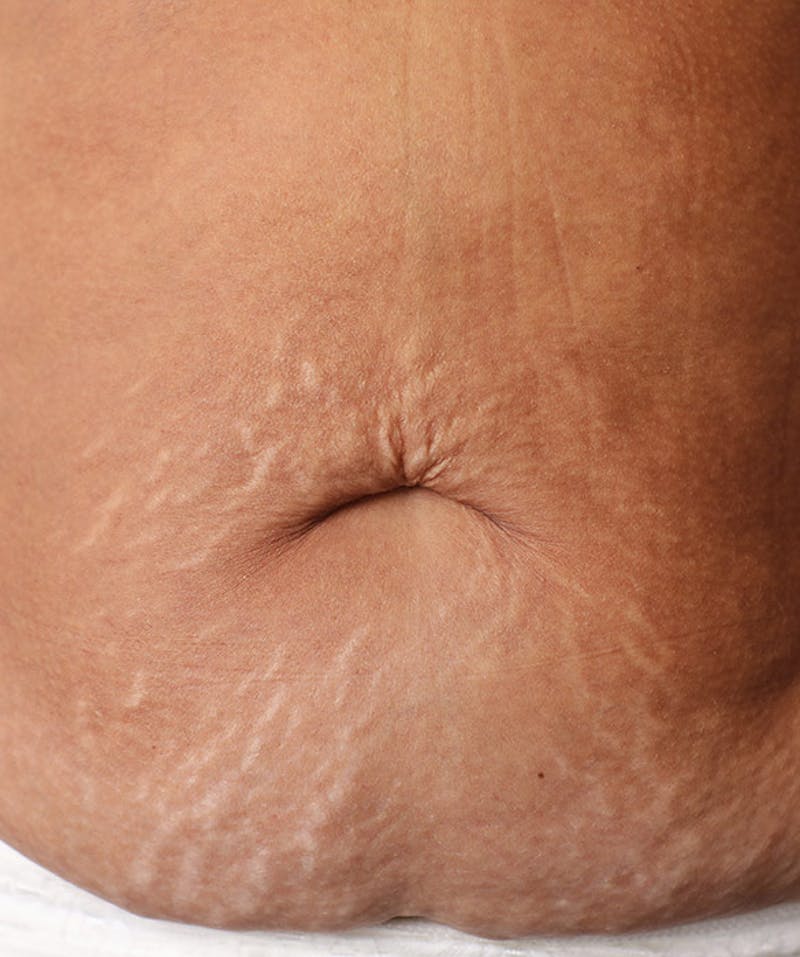 A pannus (stretched skin) of a potential panniculectomy patient