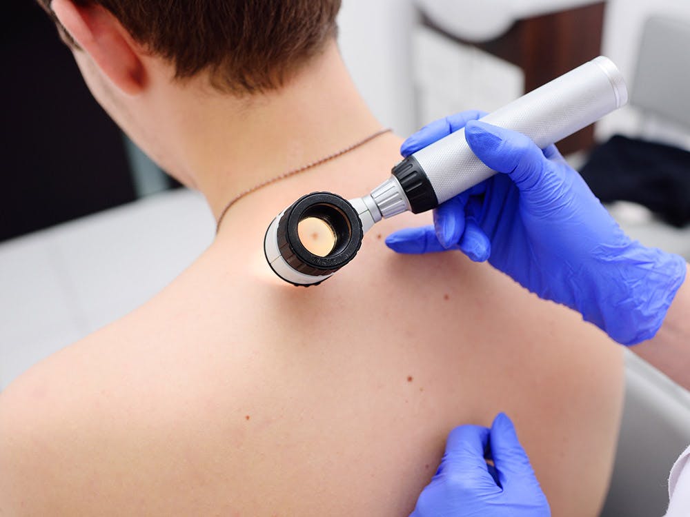 A patient getting suspicious moles examined by a doctor
