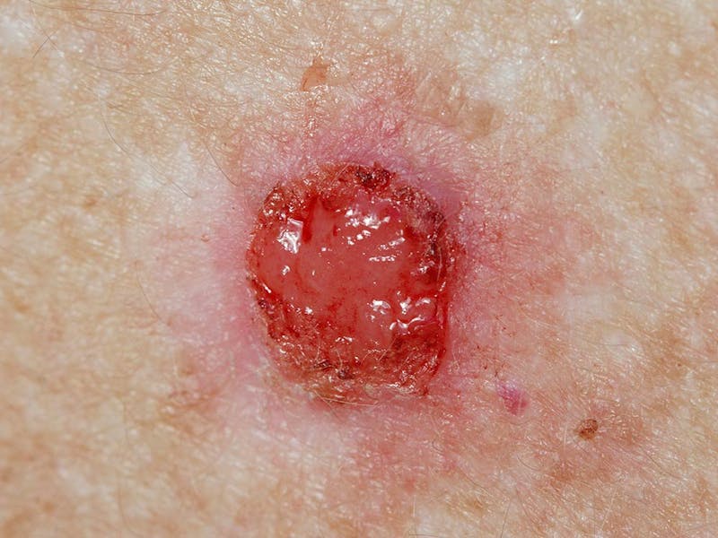 A closeup view of basal cell carcinoma