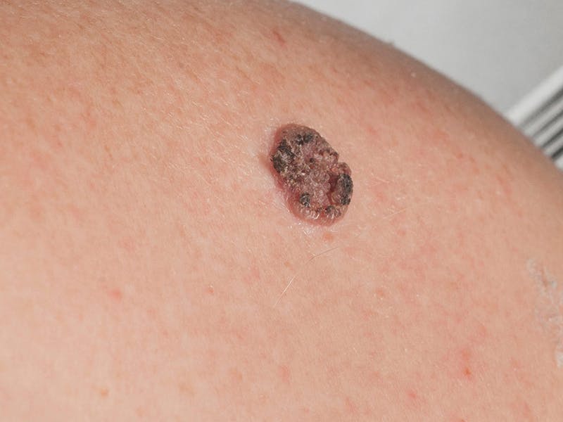 A closeup view of squamous cell carcinoma on patient's skin