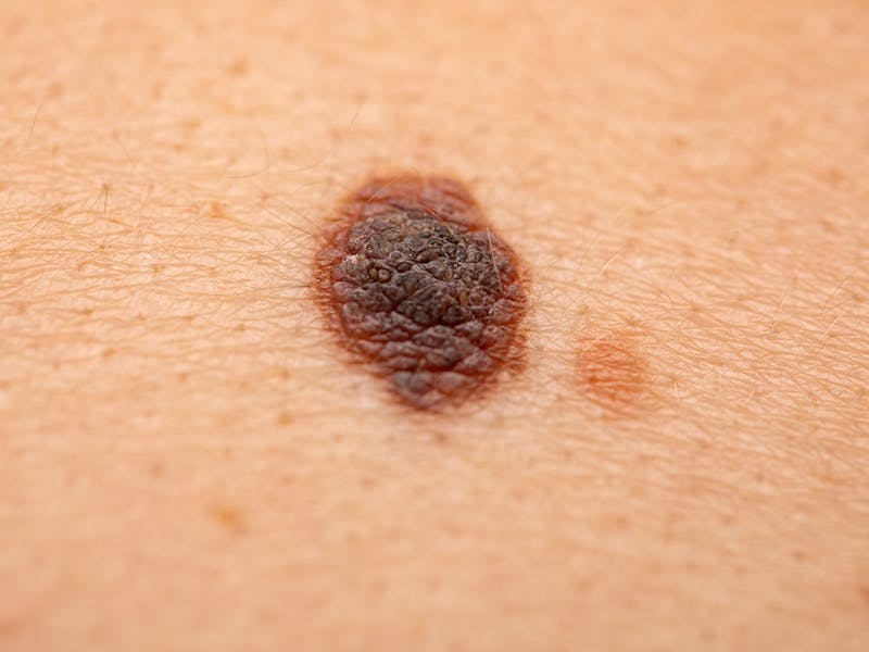 A closeup view of dangerous looking melanoma
