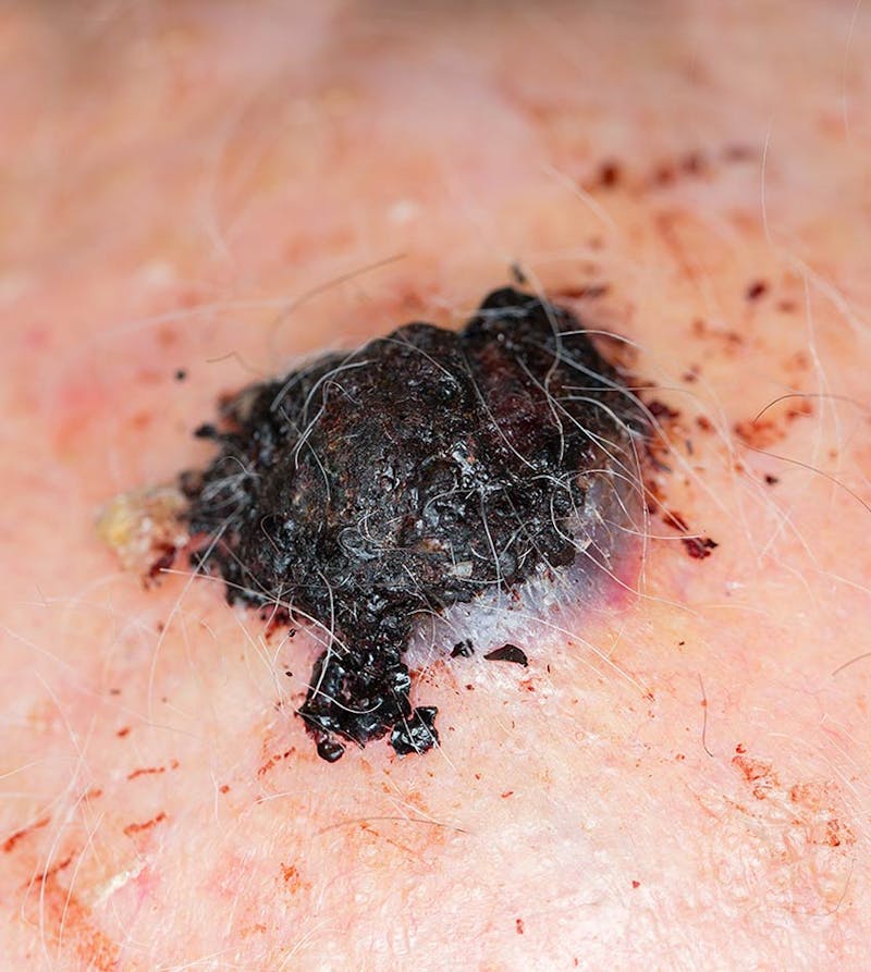 A closeup view of melanoma