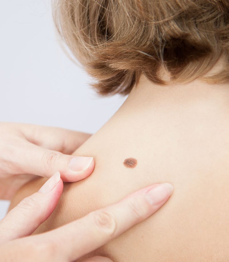 A doctor examining a suspicious melanoma on patient's shoulder