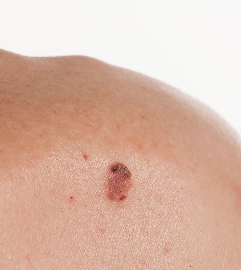 Closeup view of squamous cell carcinoma