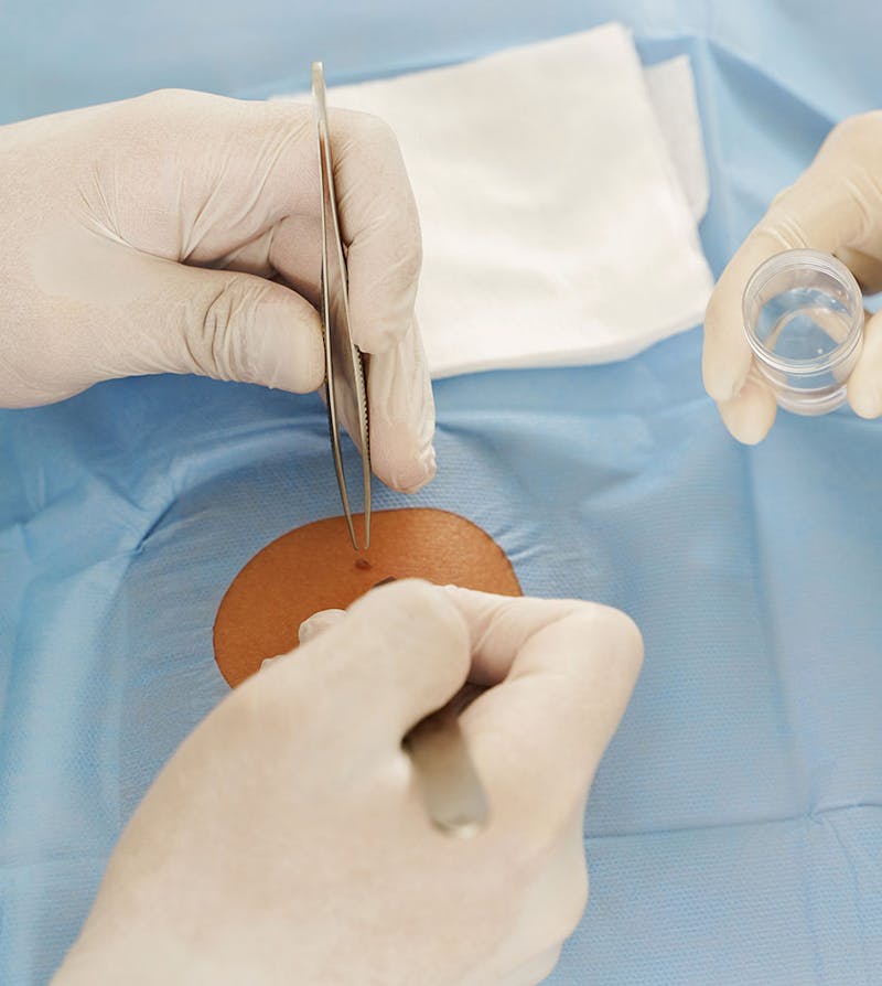 A physician taking a biopsy of a suspicious mole on patient's back
