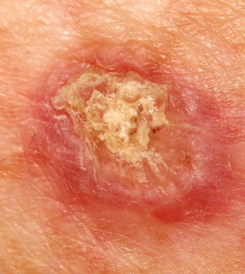 Closeup view of squamous cell carcinoma