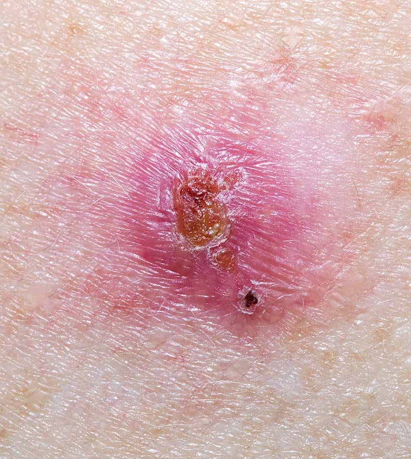Basal cell carcinoma showing crust and bright pink appearance