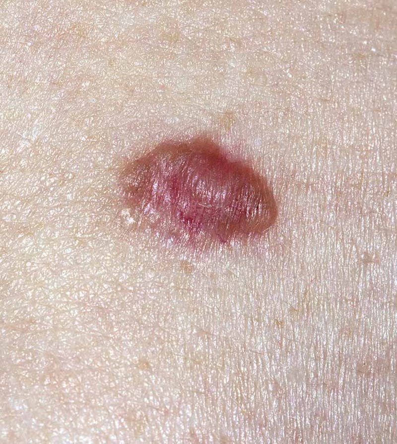 Basal cell carcinoma appearing bright red on patient's skin