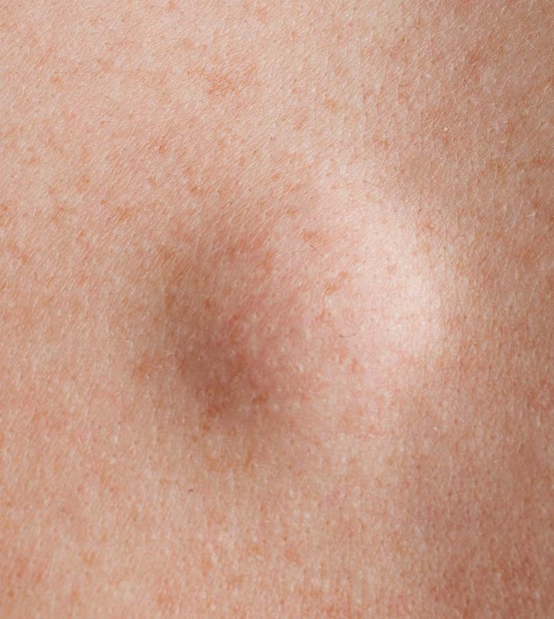 Lipoma just underneath the skin of a patient