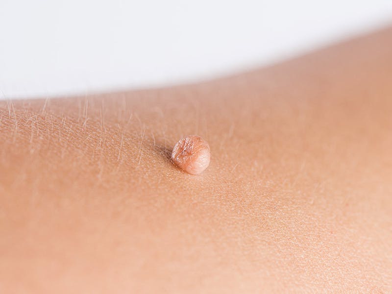 Closeup view of skin tag on patient's shoulder