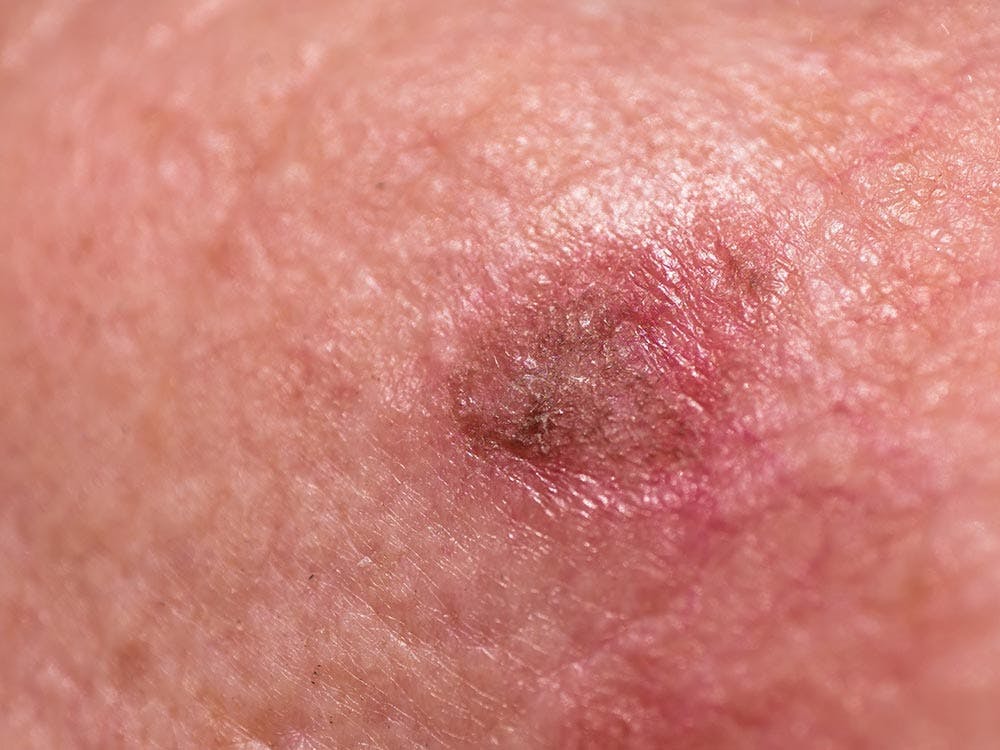 Closeup view of actinic keratosis