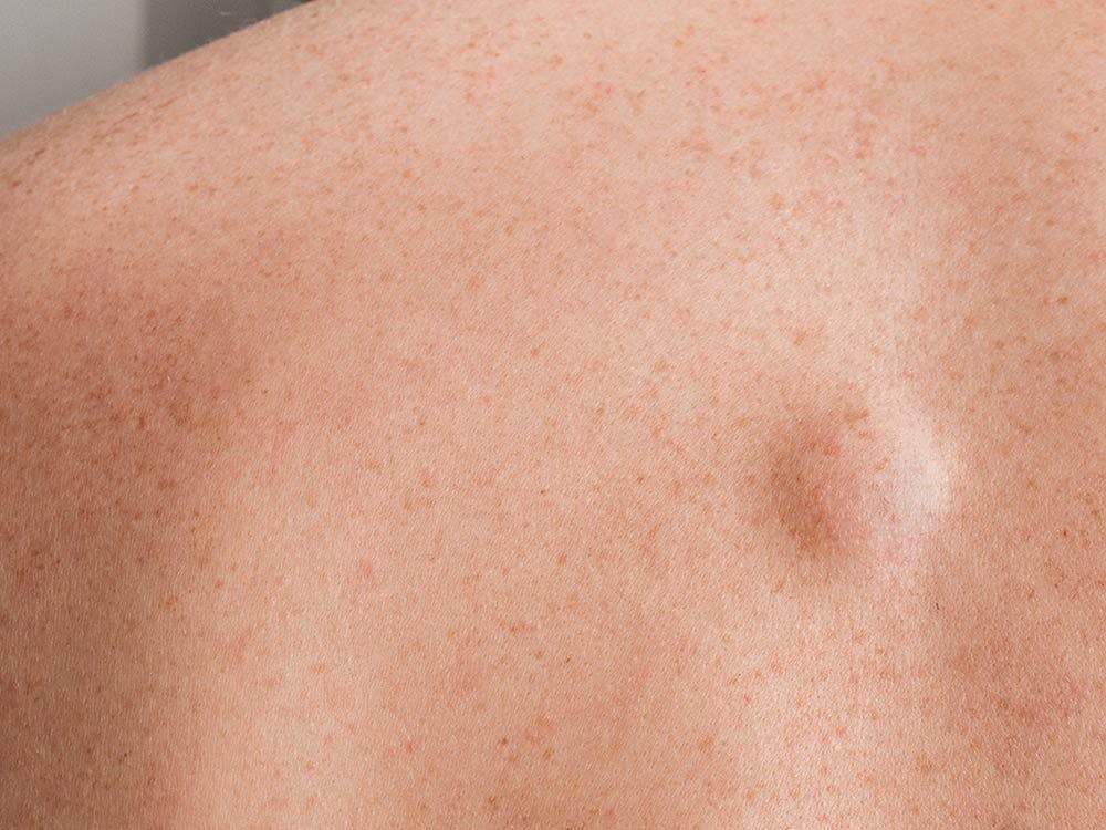 Lipoma on patient's back