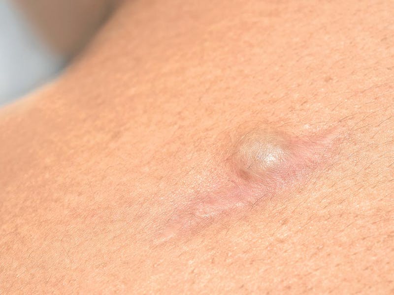 Closeup view of a epidermoid cyst on patient's back