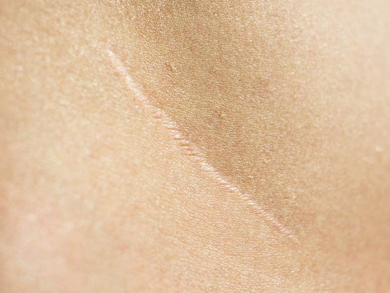 A scar on a patient that is healing very well as it fades