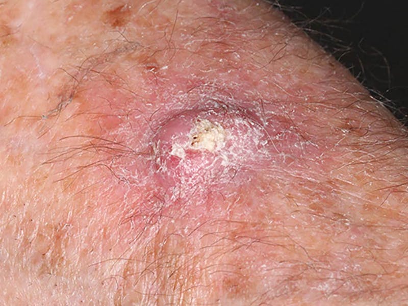 Closeup view of keratoacanthoma lesion on skin