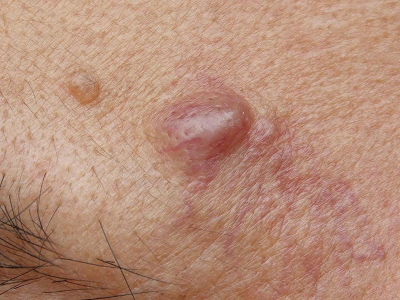 Closeup view of a cyst on top of eyelid