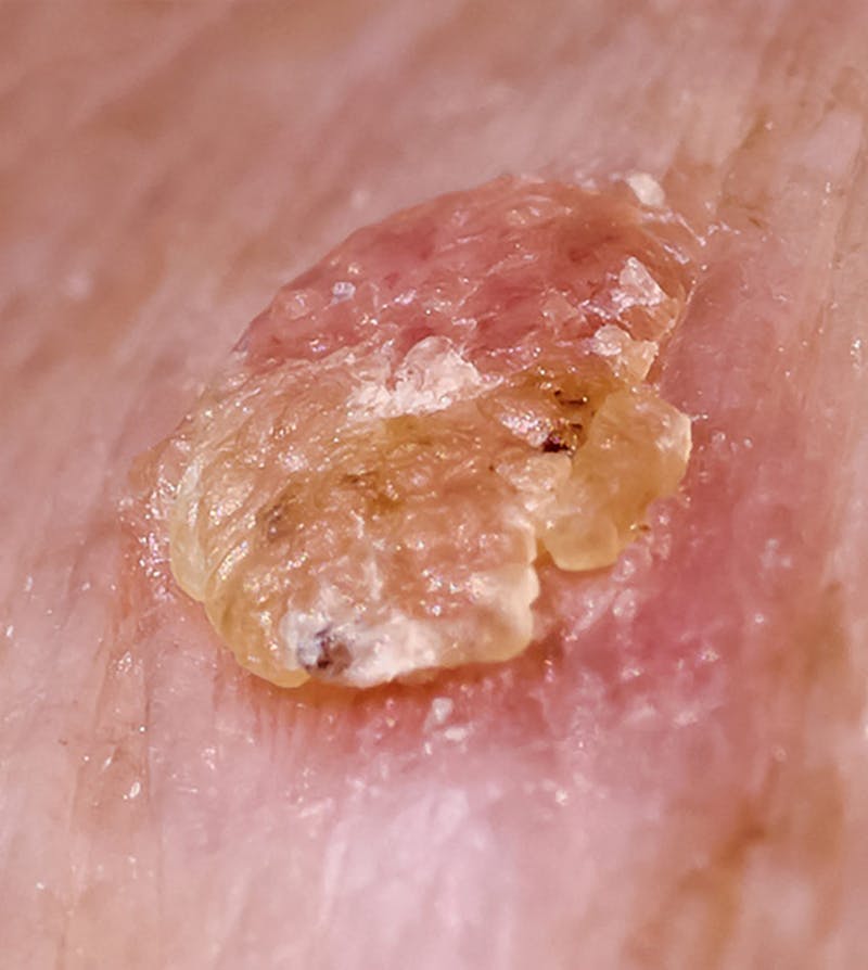 Closeup view of actinic keratosis