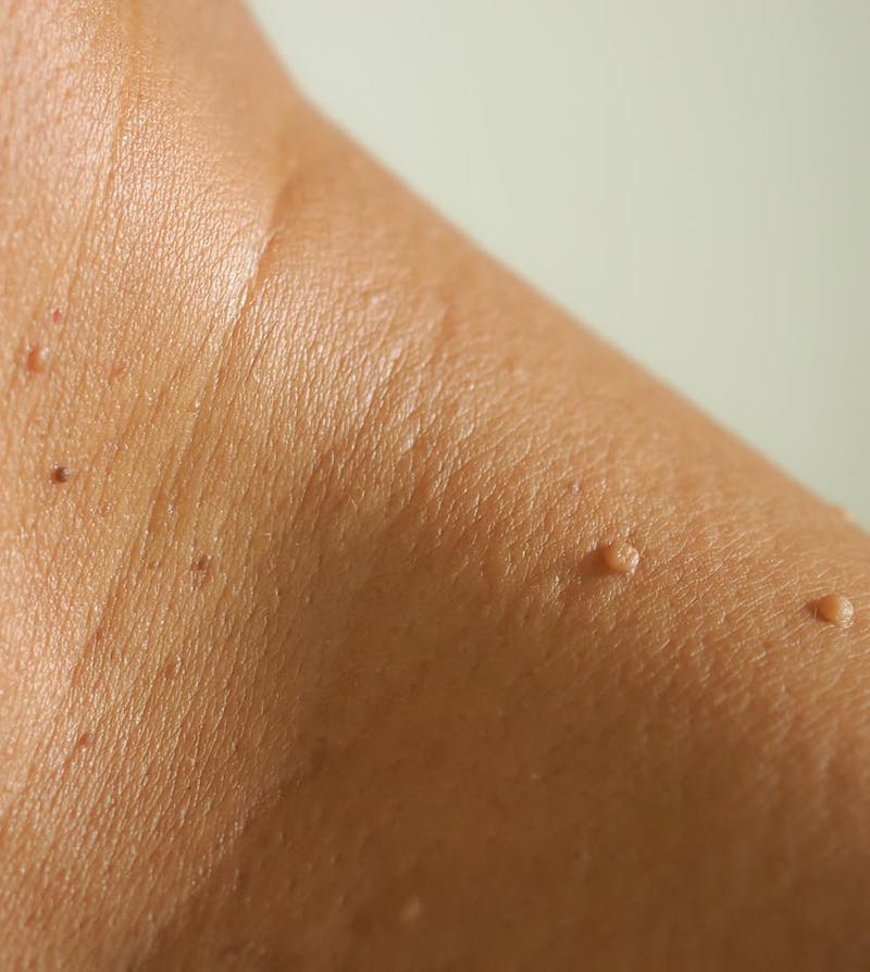 Skin tags on neck of a patient