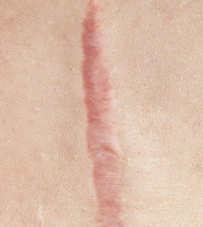 Closeup view of a hypertrophic scar on skin