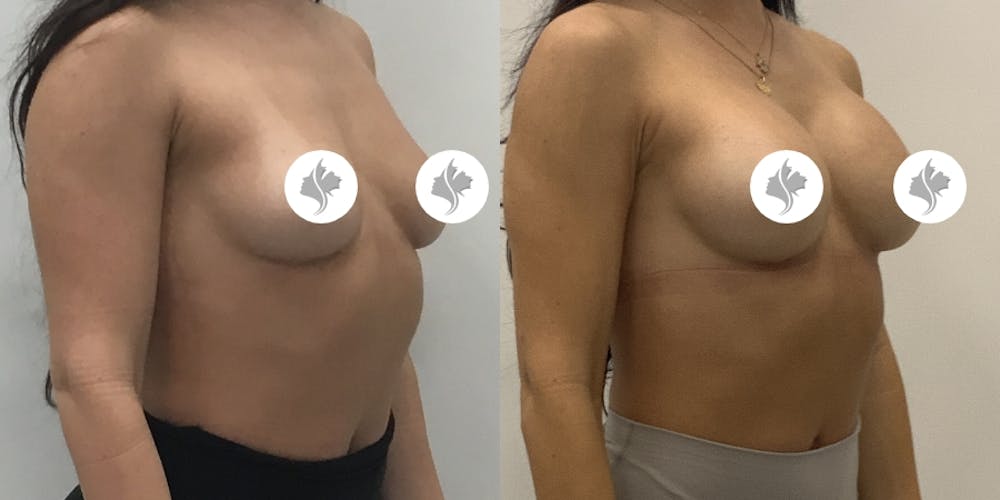 This is one of our beautiful breast augmentation patient #63