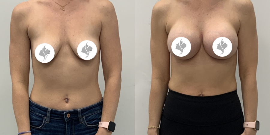 This is one of our beautiful breast augmentation patient 60