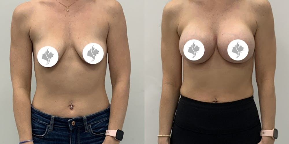 This is one of our beautiful breast augmentation patient #60
