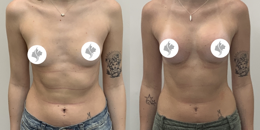 This is one of our beautiful breast augmentation patient 61