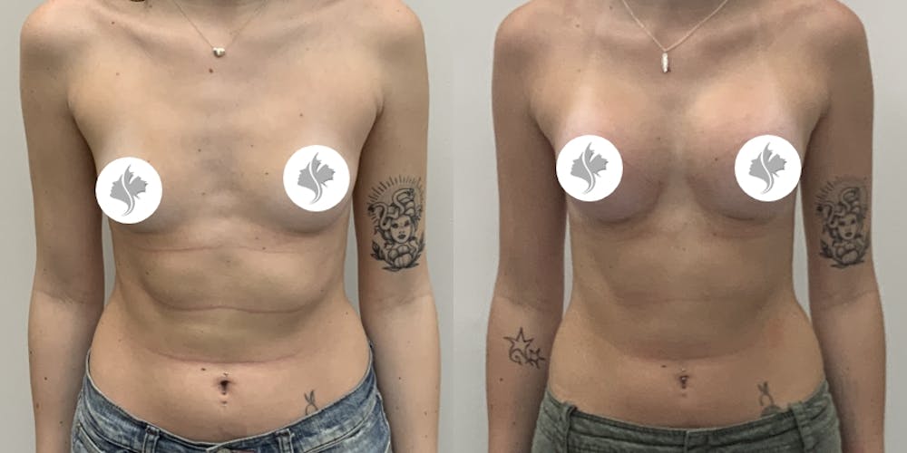 This is one of our beautiful breast augmentation patient #61