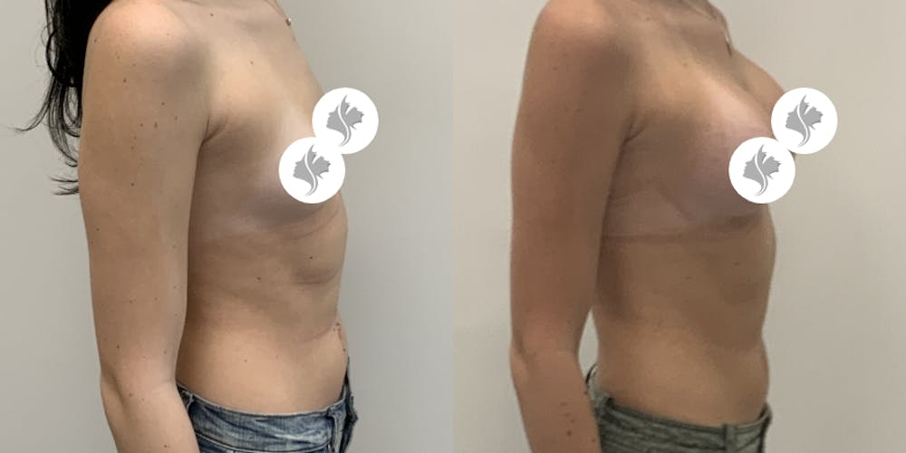This is one of our beautiful breast augmentation patient #61