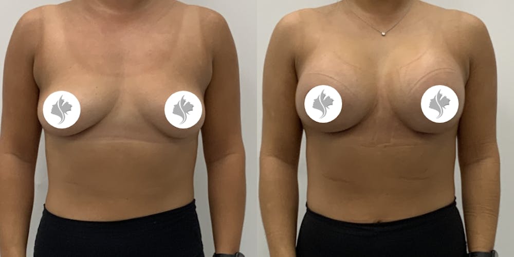 This is one of our beautiful breast augmentation patient #62