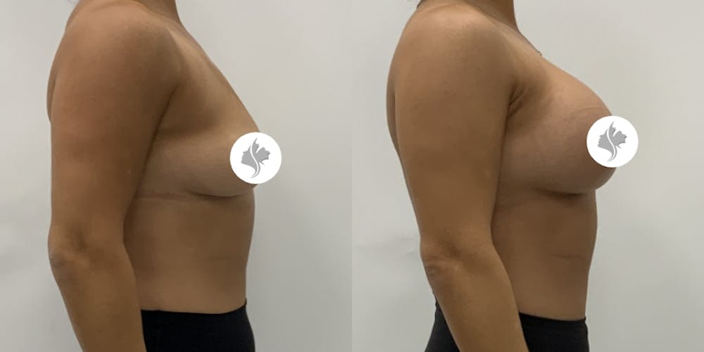 This is one of our beautiful breast augmentation patient #62