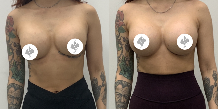 This is one of our beautiful breast augmentation patient 1