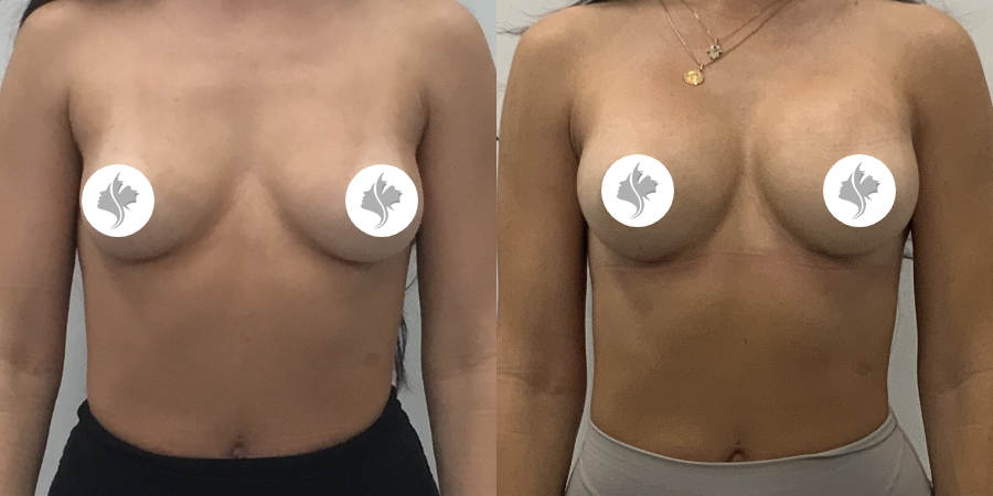 This is one of our beautiful breast augmentation patient 63