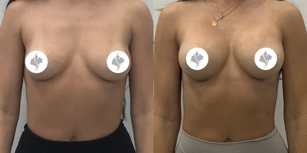 This is one of our beautiful breast augmentation patient #63