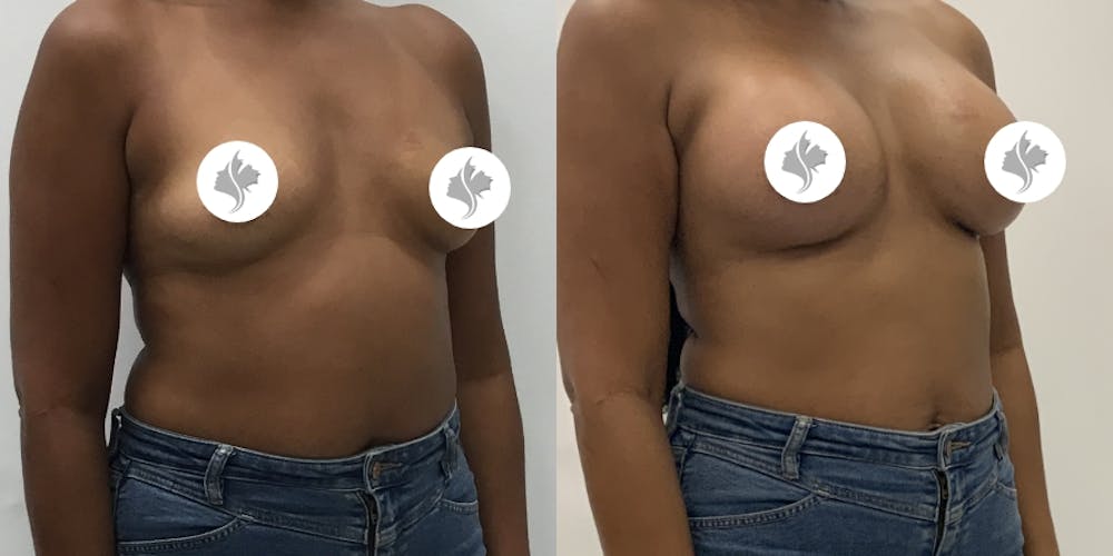 This is one of our beautiful breast augmentation patient #64