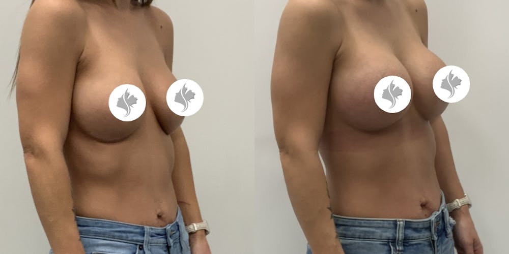This is one of our beautiful breast augmentation patient #66