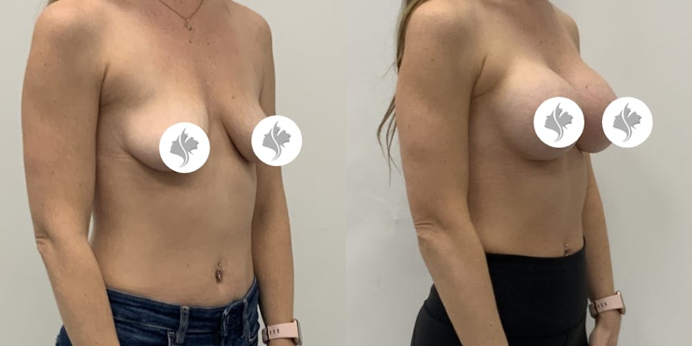 This is one of our beautiful breast augmentation patient #60
