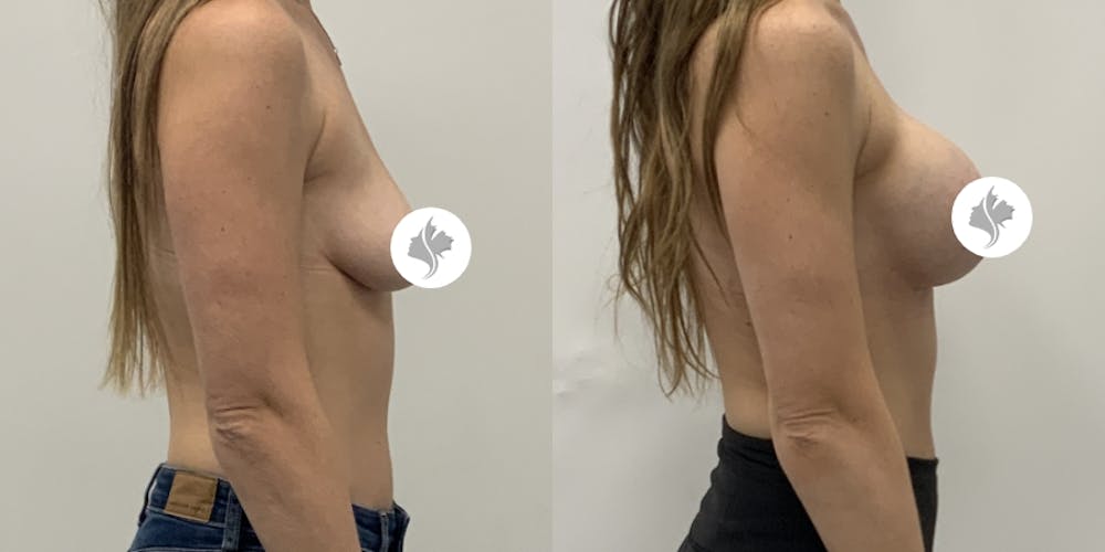 This is one of our beautiful breast augmentation patient #60