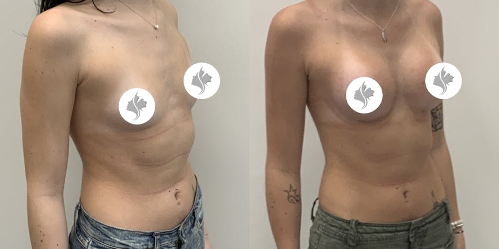 This is one of our beautiful breast augmentation patient #61