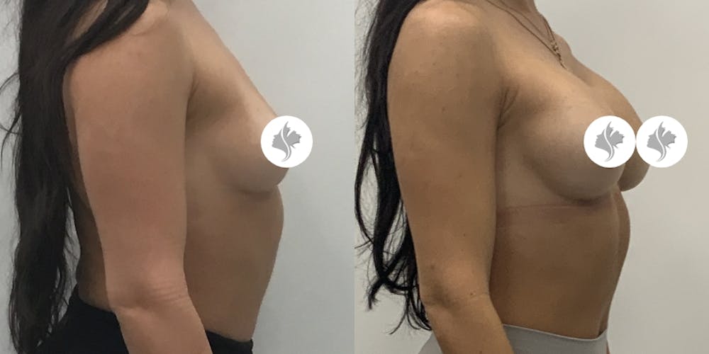 This is one of our beautiful breast augmentation patient #63