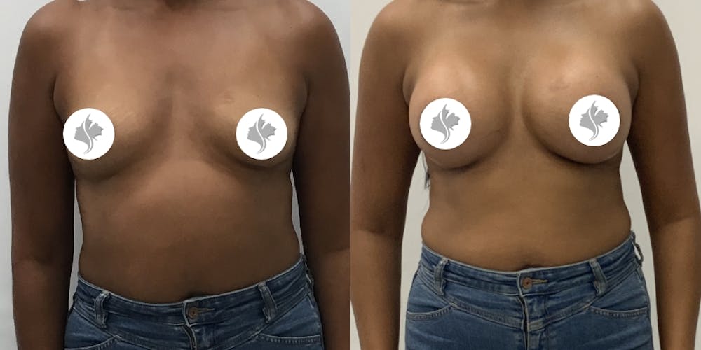This is one of our beautiful breast augmentation patient #64