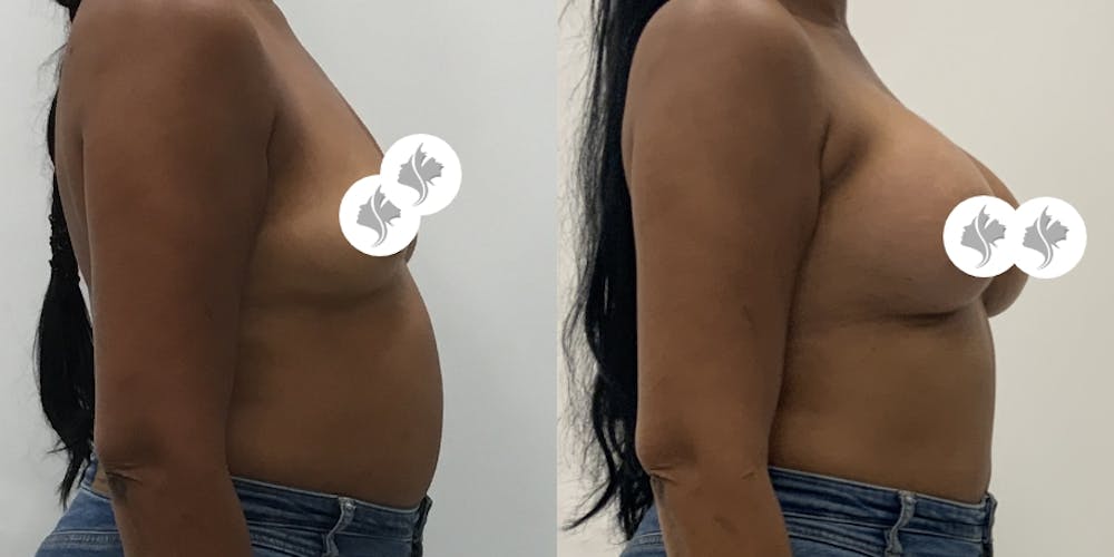 This is one of our beautiful breast augmentation patient #64