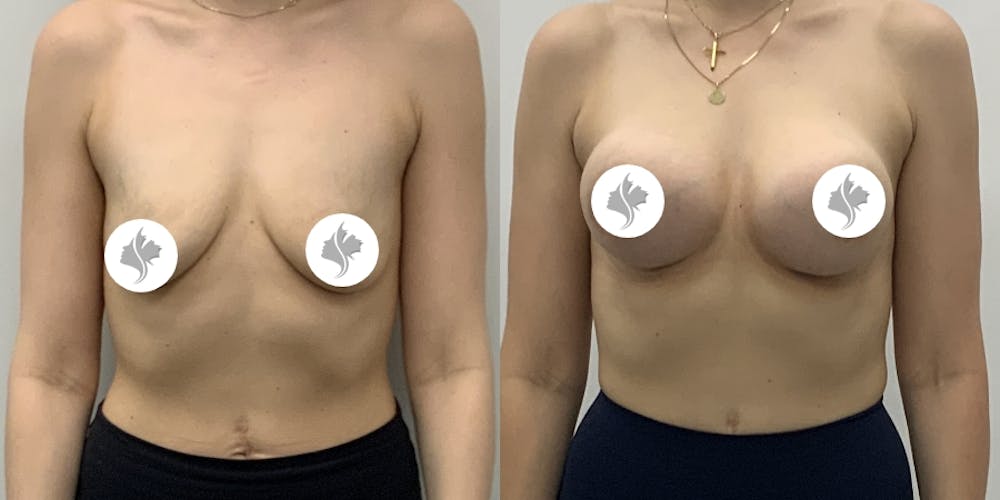 This is one of our beautiful breast augmentation patient #65