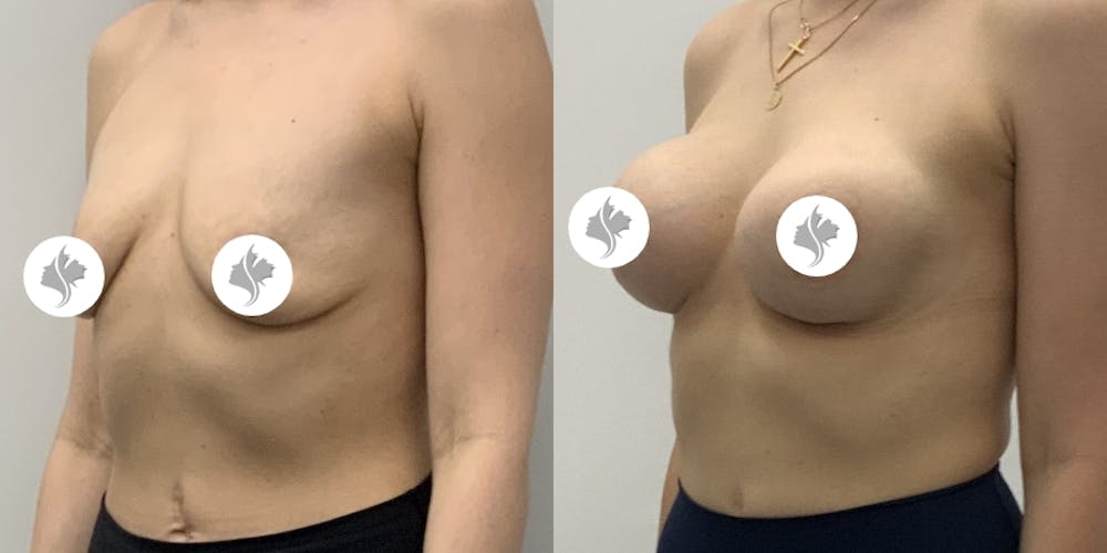 This is one of our beautiful breast augmentation patient #65