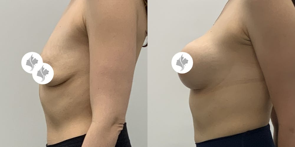 This is one of our beautiful breast augmentation patient #65