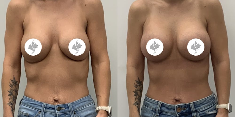 This is one of our beautiful breast augmentation patient #66